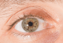 eye freckles